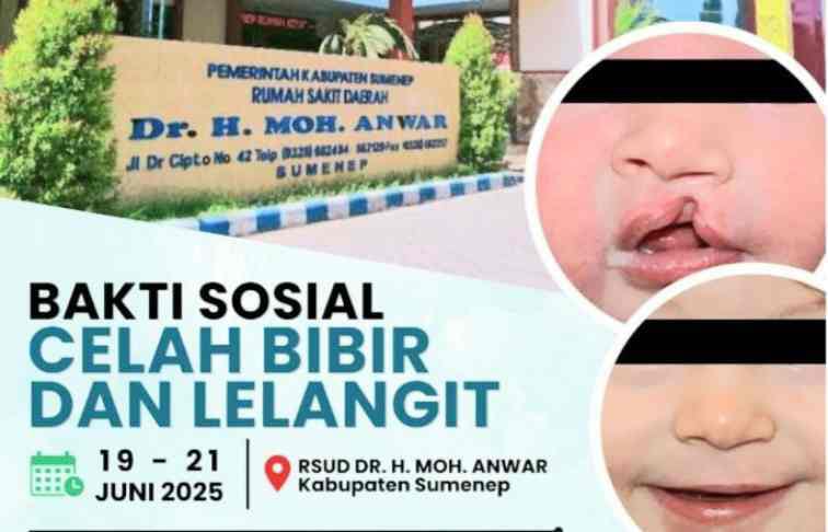 RSUD dr H Moh Anwar Sumenep Gelar Baksos Kolaboratif Operasi Celah Bibir dan Lelangit